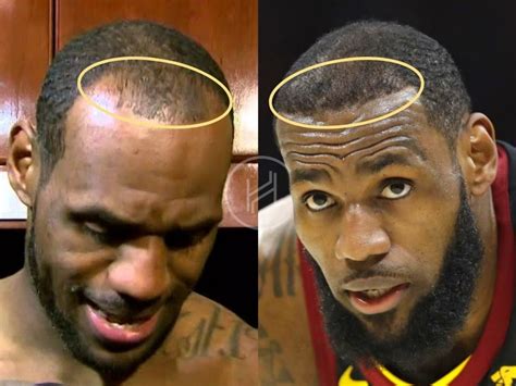 i saw lebron james hairline